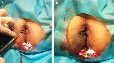Analgesic effect of subcutaneous injection of different concentrations of methylene blue after hemorrhoidectomy: A retrospective study